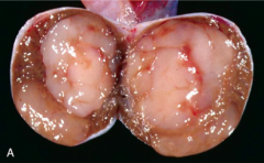 You find a mass that is ENLARGING the testicles, PALE, and ***SOFT***, what is your diagnosis?