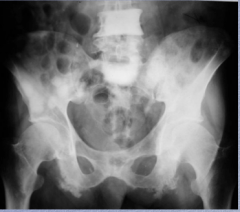 Bone metastases are very common. Are they almost always osteoblastic or osteolytic?