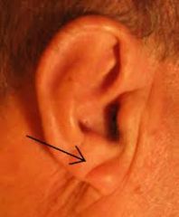 Pliegue lóbulo de la oreja


enfermedad coronaria