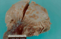 Tumors cells surrounding the peritoneal cavity