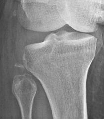 A fracture in which a fragment of bone is separated from the main bone mass.