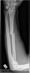 A fracture at a right angle to the bone's axis.