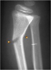 An incomplete fracture in which the bone is bent. This type occurs most often in children.