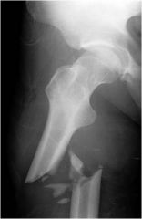 A fracture in which the bone fragments are driven into each other.