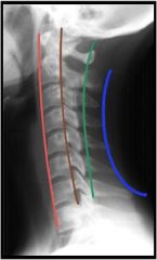 Anterior vertebral line (r) -anterior vertebral bodies
Posterior vertebral line (br) -posterior vertebral bodies
Spinolaminar line (g) -posterior spinal canal
Posterior spinous line (bl) -tips of spinous processes
Misalignment indicates  ligam...