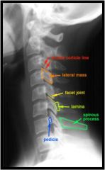 Pedicles - L/R should superimpose on lateral
Facets - double cortical lines, distance should be equal at all levels
Lamina - posterior poorly seen on lateral
Spinous processes - increase in size
- Vertebral bodies should line up in arch
- Eac...