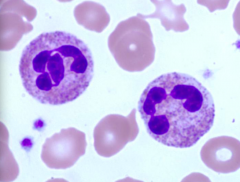 Case 1: 17yo complains of fever, sore throat, enlarged neck lymph nodes, nausea, and weakness for 1 week. CBC shows leukocytosis (↑WBC count: 30,000/µL) and normal Hb and platelet count.

The cells that appear to be numerically increased int ...
