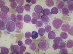 Acute Myeloblastic Leukemia without Cytologic Maturation (AML)