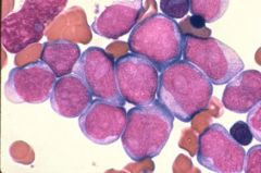 Acute Myeloblastic Leukemia without Maturation (AML)

