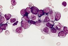 Acute Myeloblastic Leukemia with Maturation (AML)