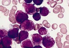 Acute Promyelocytic Leukemia (APL)