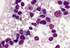Acute Monocytic Leukemias (AMoL) - poorly differentiated