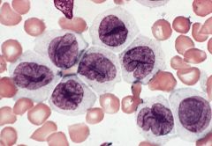 Acute Monocytic Leukemias (AMoL) -differentiated