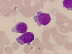 Acute Megakaryocytic Leukemia -