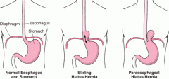 Sliding - Hiatus hernia where the gastroesophageal junction slides up into the chest dragging the upper stomach (gastric cardia) with it. 

Rolling - Gastroesophageal junction remains in the abdomen but a bulge of part or all of proximal stomach...