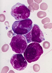 Case 3: 22yo male presents with weakness and blood oozing from nose and mouth. Petechiae and ecchymoses over most of body. 

↑ WBC count: 50,000/µL, ↑ D-dimers, prothrombin time, and partial thromboplastin time, consistent w/ Disseminated I...