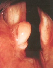 Bilde av et kontaktgranulom på larynx. Hva kan føre til disse granulomene?