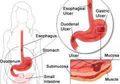 1.Peptic (in lining of stomach or duodenum)
2. Gastric (in stomach)
3. Duodenal (in duodenum) MOST COMMON