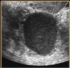 what is this adnexal structure with homogeneous low-level eches?