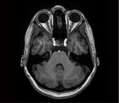 What brainstem level is shown in this MRI?