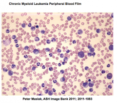 










Peripheral blood smear shows granulocytosis with
all stages of maturation.