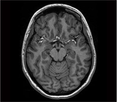 What brainstem level is shown in this MRI?