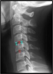 Disk spaces should be:
- symmetric
- equal in height at anterior and posterior margins
- equal height at all levels
Degenerative disease in older patients may lead to spurring and loss of disc height.