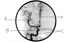 What artery is injected with contrast? What view is this?