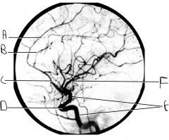What artery is injected with contrast? What view is this?