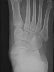 An 18-year-old male complains of a painful prominence over his medial midfoot for the past 2 years; NSAIDs and orthotics have failed to provide relief. Physical exam demonstrates a firm, nonmobile, tender bump on the medial midfoot with no skin ch...