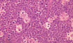 - Diffuse infiltrate of intermediate-sized lymphoid cells
- High mitotic index 
- Contains numerous apoptotic cells
* Starry sky pattern d/t macrophages being surrounded by abundant clear cytoplasm