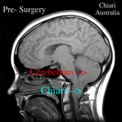 congenital deformation of BS and cerebellum; medulla and/or cerebellum displaced down thru foramen magnum