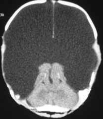 cerebral hemispheres replaced by cystic sacs w/ csf. may be due to vasc occlusion. hydrocephalus = anencephaly.