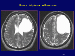 large cystic lesion develops, cd be vasc occlusion, severe trauma, infection. oft assoc w/ MR, epilepsy