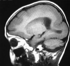 disorder of cell migration, characteristic facial appearance- prominent forehead, short nose, small jaw. assoc w/ agenesis of CC, microencephaly, epilepsy, retarded growth, szs, low responsivity. cd be agyric or pachygyric (few gyri)