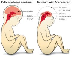 How common is (Mero)Anencephaly? What is it associated with?