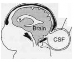 - Small defect in skull
- No brain tissue herniation
- Meninges pass through defect 
- Forms a sac beneath skin filled w/ CSF