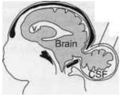 Cranium Bifidium (interchangeably used w/ encephalocele which refers to herniation of brain/meninges through opening)