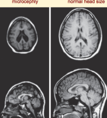 - Decreased neuron proliferation
- Undersized brain
- Small cranial vault
- Severe mental retardation
- Associated w/ 150 syndromes (20% genetic, some teratogenic)