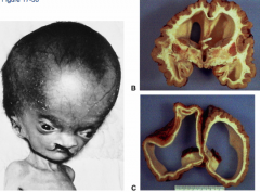 What are the two types of Hydrocephalus?