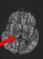 - Because both hemispheres involved
- If only half the cerebrum involved, typically will NOT have altered consciousness (although they will have focal deficits)
- MRI: anoxic brain injury bilaterally to cortex and thalami