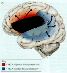 What are the characteristics of a Broca's Aphasia?