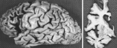 Frontotemporal Dementia (Pick's Disease)
- Changes in personality --> prefrontal cortex
- Poor judgment --> prefrontal cortex
- Inappropriate behavior --> orbitofrontal cortex