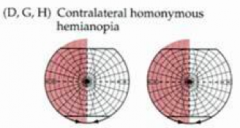 - L Homonymous Hemianopia 
- Right occipital cortex mediates vision from Left hemifield of both eyes