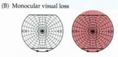 If there is a monocular visual defect, what is likely the cause?