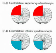 - Lesion to Meyer's loop (temporal optic radiations) --> contralateral superior quadrantanopia
- Lesion to Parietal Optic Radiations --> contralateral inferior quadrantanopia