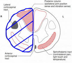 - Ipsilateral loss of fine discrimination, joint position, vibration immediately below lesion
- Contralateral loss of pain and temp; loss is complete by 2-3 segments below lesion
- Minor: some loss of crude touch on contralateral side
- Patient present