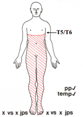 - Loss of fine discrimination, vibration, joint position below lesion
- Pain and temp OK throughout body