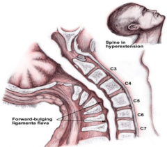 - Syringomyelia: tube-like enlargement of central canal from excess fluid; gliosis, cysts formed in central form of cord
- Hyperextension of cervical spine - damages center of cord