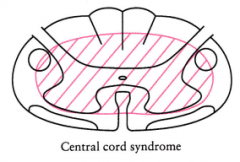 What are the implications of a large lesion / central cord syndrome?